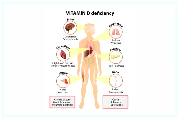 Vitamin D Deficiency: Causes, Symptoms, Food, and Treatment